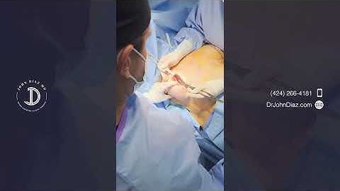 Correcting Capsular Contracture