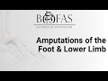 Amputations of the foot  lower limb  bofas lectures of distinction