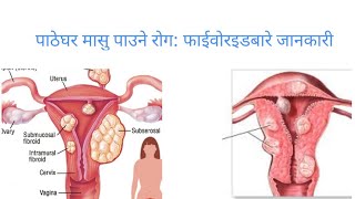 Fibroid in Uterus in Nepali|Dr Ramesh Shrestha|doctor sathi