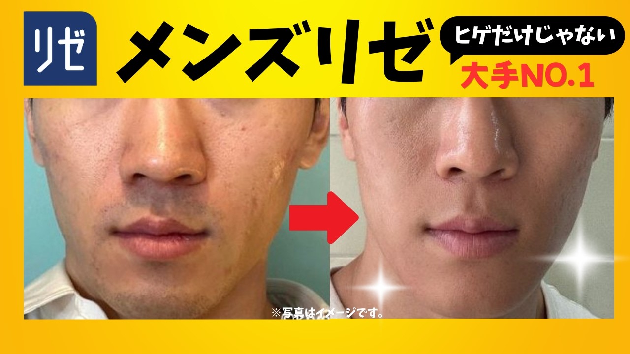 The Pinnacle of Men's Hair Removal] The Reasons Why Men's Rize is