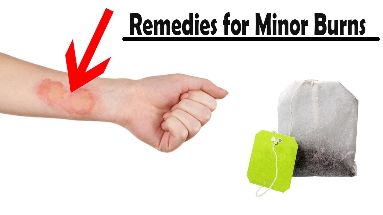 5 Effective And Easy Home Remedies For Minor Burns Youtube