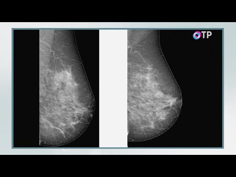 Видео: 11 вопросов, на которые ответил навигатор по раку молочной железы