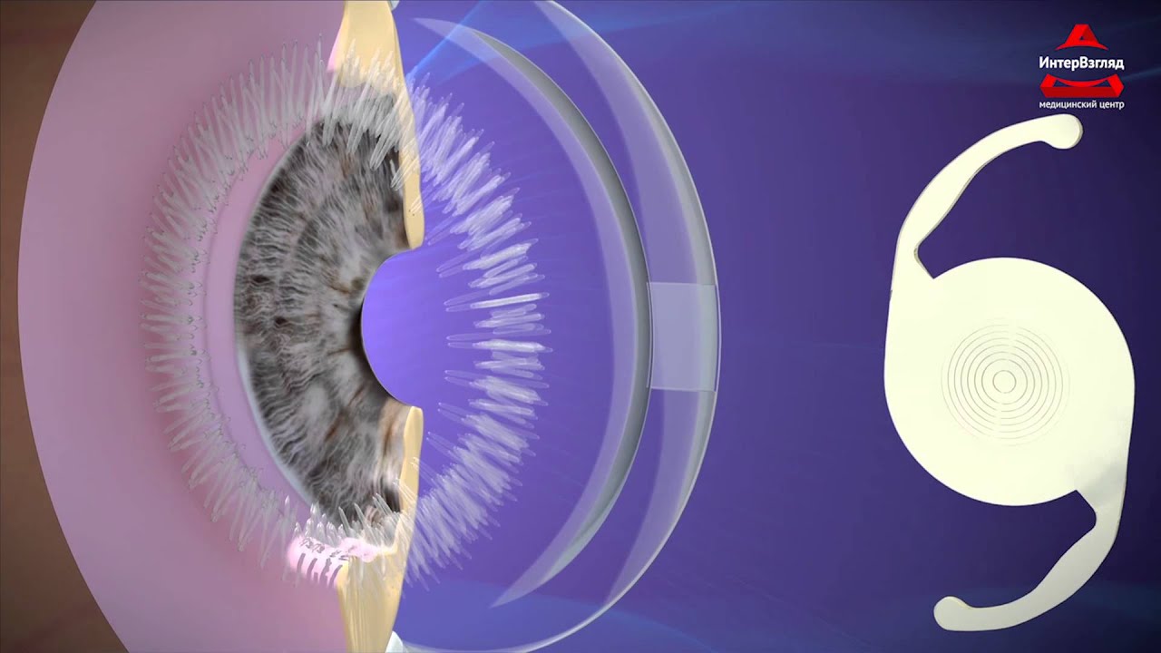 Как вылечить катаракту? Процесс удаления катаракты - YouTube