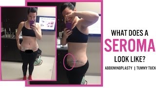 What Does a SEROMA Look like After an Abdominoplasty / Tummy Tuck?