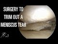 Meniscus tear: Partial meniscectomy, or surgery to trim out the tear