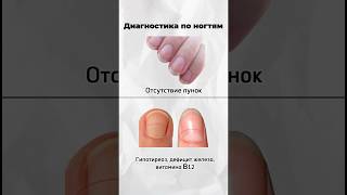 Как заподозрить дефициты витаминов и минералов по состоянию ногтей