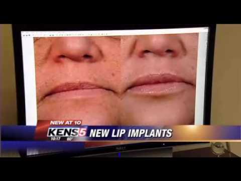 PermaLip Implants - YouTube