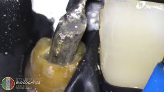 🥰Enjoy the video of a clinical case shared by Dr. Riccardo Tonini with UltraMint Pro and Ultra X