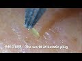 【No.10】角栓連続抜き!Keratin plug mass excl.