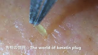 【No.10】角栓連続抜き!Keratin plug mass excl.