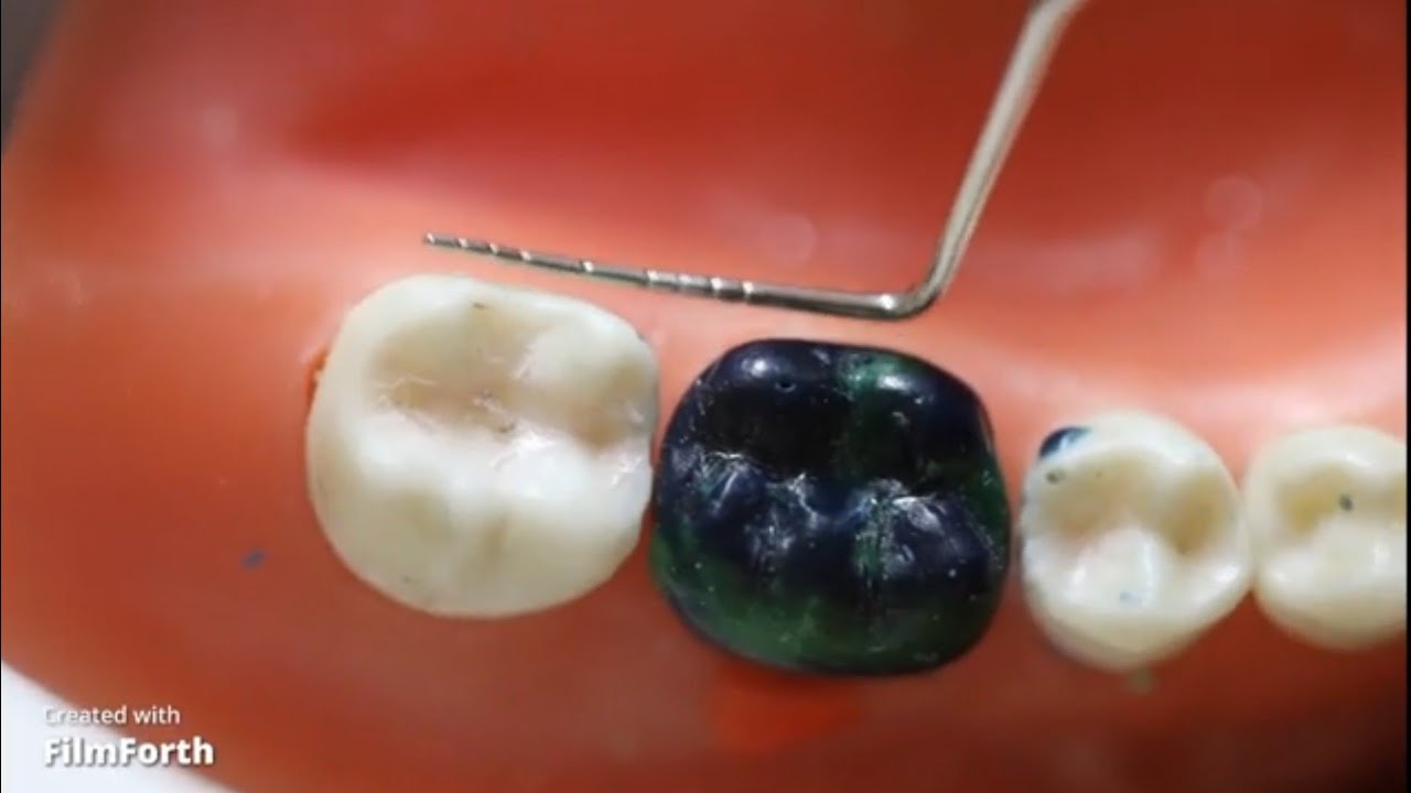 Wax Pattern Mand. 1st Molar part 2