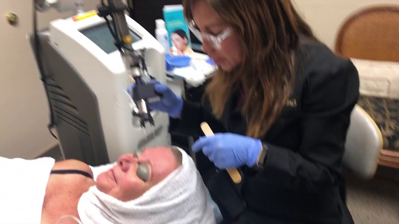 CoolPeel kezelés DEKA Smartxide Punto lézerrel -  Dr. Christine Petti