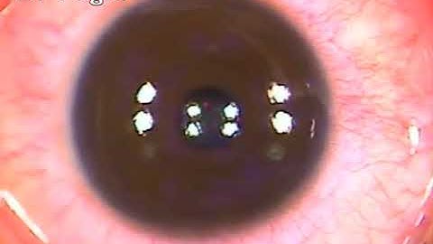 Topography guided PRK - most advanced and safest technique of laser refractive surgery