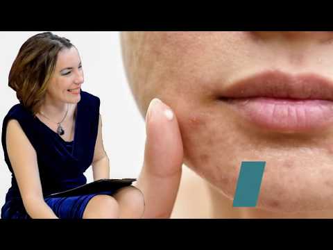Video: Cum Se Poate Gestiona Durerea Acneei Nodulare
