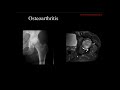 imaging Osteonecrosis