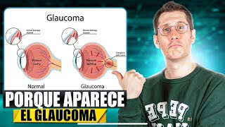 GLAUCOMA: ¿Qué lo Causa? ¿Cómo se Desarrolla?