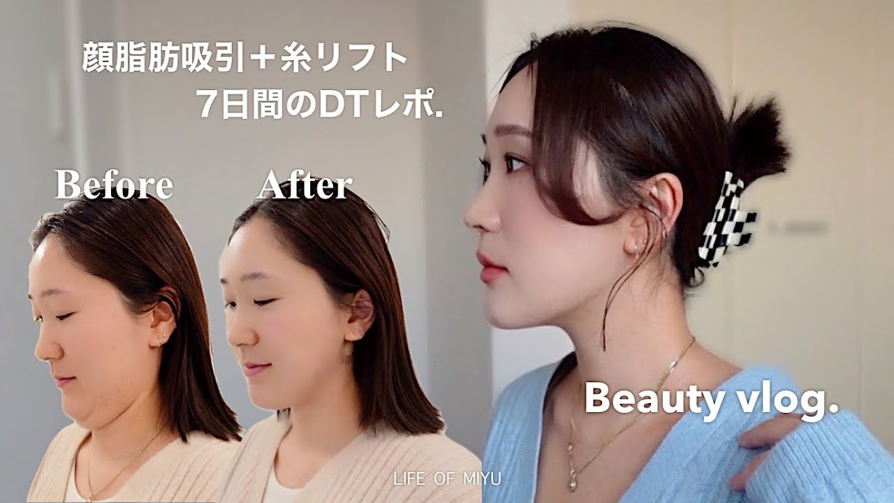 整形vlog | 顔の脂肪吸引＋糸リフトの1週間ダウンタイムレポ（クリニック, 痛み, 施術箇所etc...）