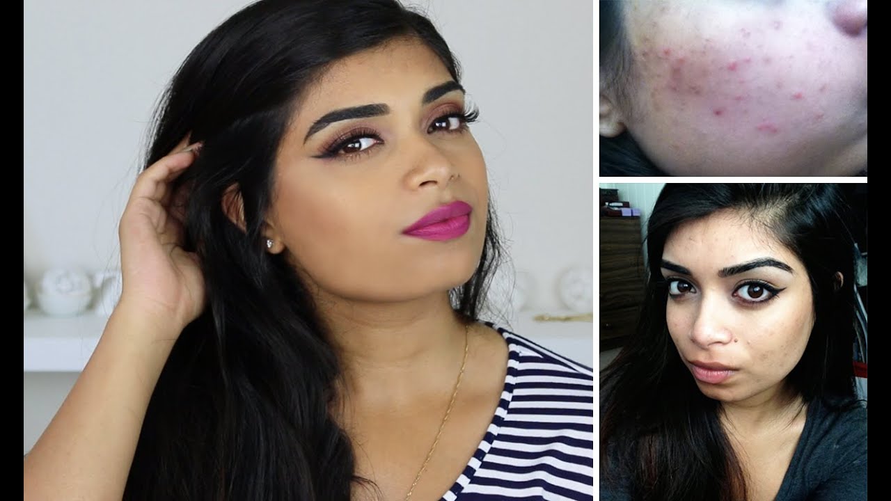 How I Got Rid of My Acne | Tips & Tricks for Clear Skin! - YouTube