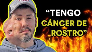 VIVIR CON CÁNCER DE ROSTRO (Entrevista a Sebastián Amurín)