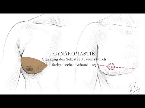Gynecomastia Fix: Life-Changing Results #plasticsurgery #aestheticvideo