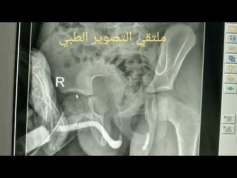 كيفية إجراء فحص الأشعة بالصبغة للمثانة وقناة البول