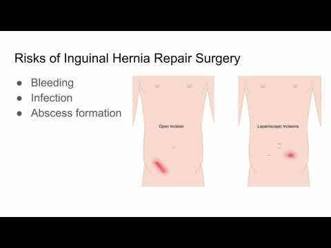 Inguinal Hernia Repair Surgery, Risks and Outcomes - CHI Health
