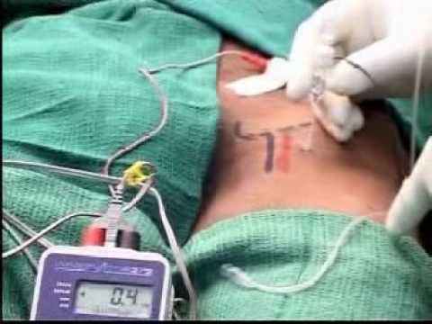 femoral nerve block - youtube femoral nerve block - youtube, Muscles