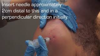 Injection Technique into the Subacromial Space for Rotator Cuff Related Shoulder Pain