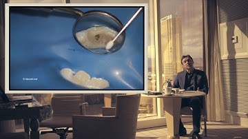 One Step Apexification using BioCeramic Putty