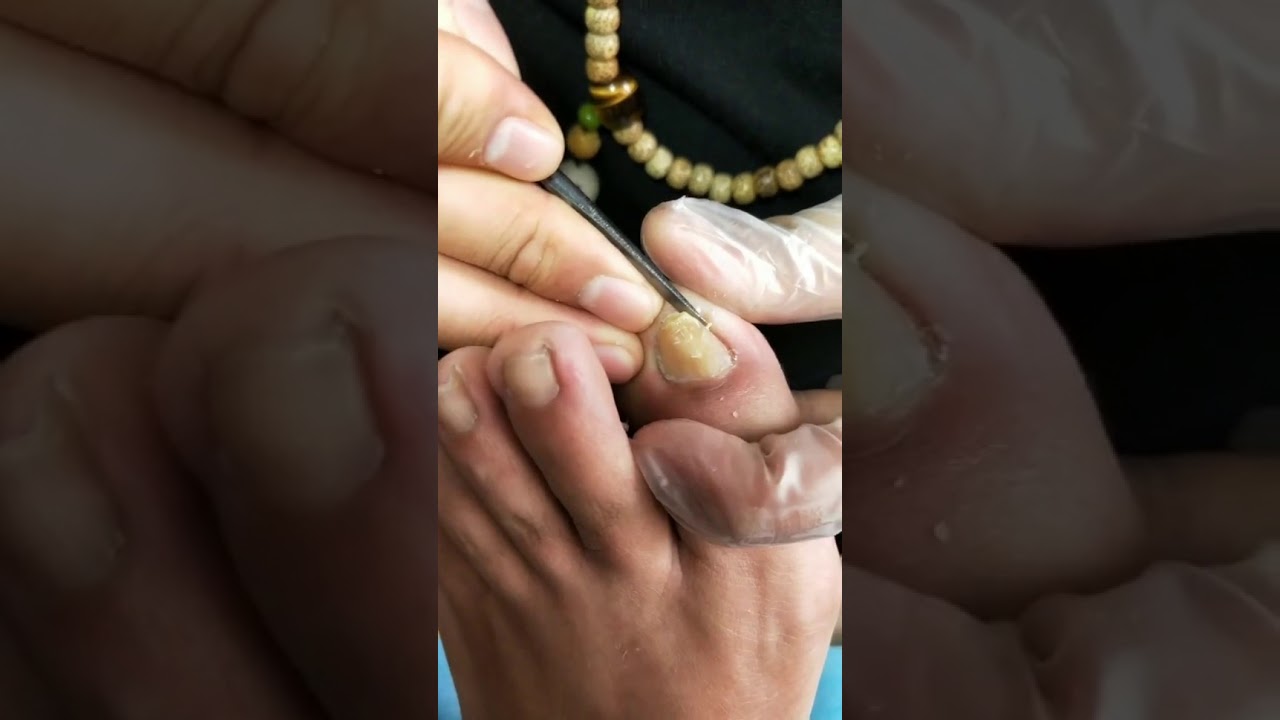High tech pull out Ingrown ToeNail 489 YouTube
