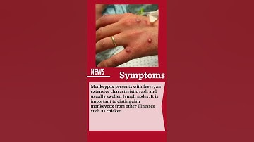 Monkeypox Virus Outbreak 