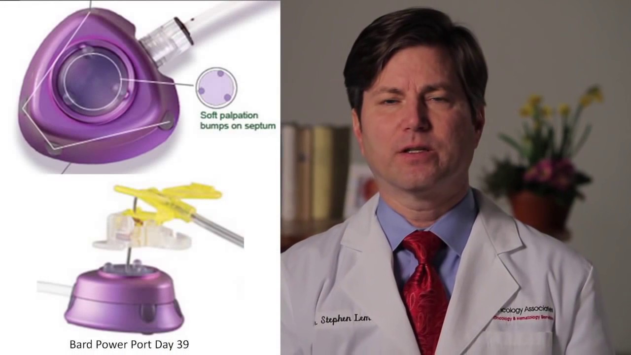 Cancer Information Video: Portacaths for Chemotherapy