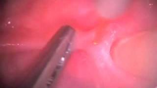 Frenectomy - Dr. Graeber showcases the Navigator Laser from Ivoclar Vivadent