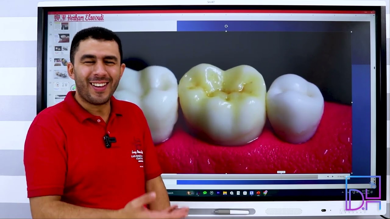 9- Crowns Classifications (Full Coverage) P2