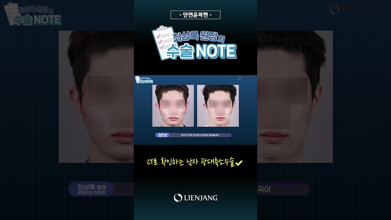 [Риэнжан гоо сайхны эмнэлэг] КТ-ийн шинжилгээгээр хардаг эрэгтэй хүний шанаа яс багасгах мэс засал #shorts