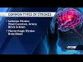 Stroke Awareness: Quick action saves lives