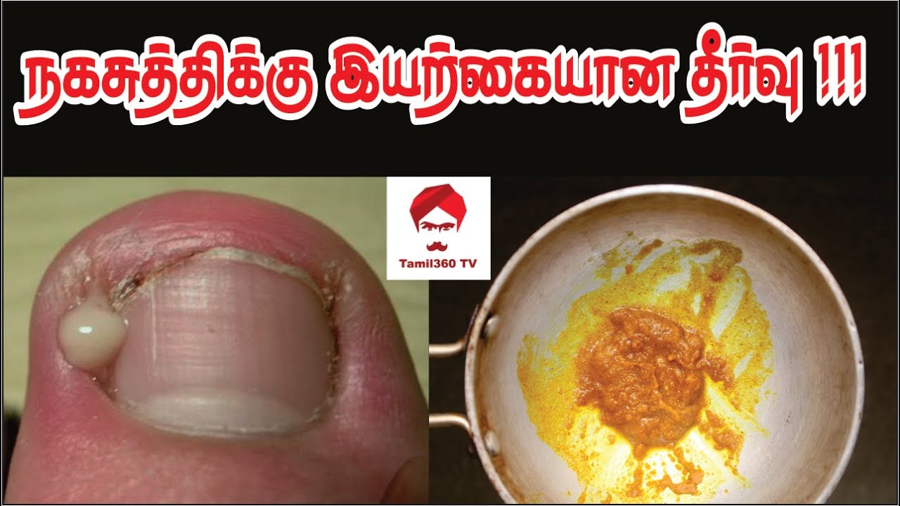 Ghee For Cracked Heels: பாத வெடிப்பால் ரொம்ப அவதியா? அதுக்கு இந்த இரண்டு  பொருள்கள் போதும் | How To Cure Cracked Heels With Desi Ghee In Tamil |  Onlymyhealth Tamil