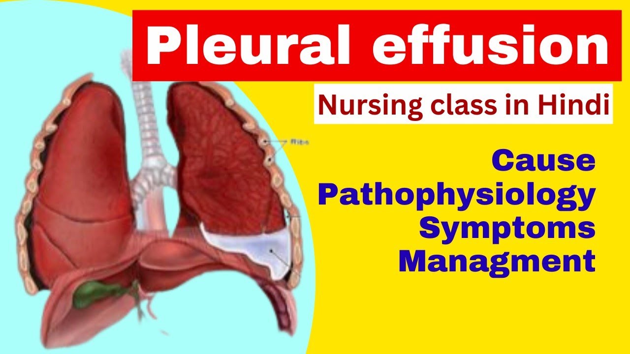 Pleural effusion in hindi cause, pathophysiology, symptoms