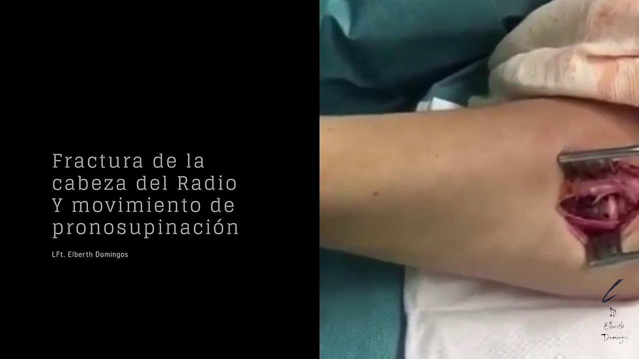 Cabeza de radio de fractura Cabeza de radio de fractura