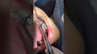 ازالة حشو البلاتين||Removal of the amalgam filling|| loại vật liệu hàn răng chứa Thủy ngân cần được