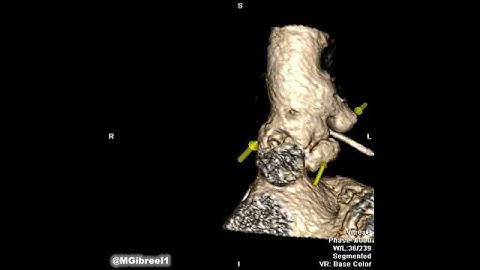 Pseudoaneurysms  of the aortic root and ascending aorta