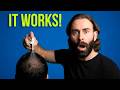This Spray Regrows Your Hair In 6 Months (No Finasteride Or Minoxidil)