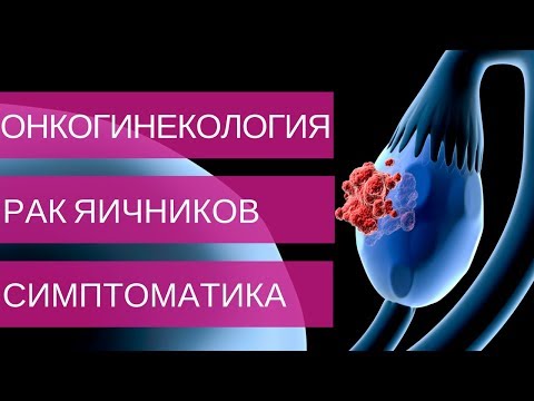 РАК ЯИЧНИКОВ симптомы и диагностика на 1, 2, 3, 4 стадии