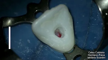 O que é fazer acesso no dente?
