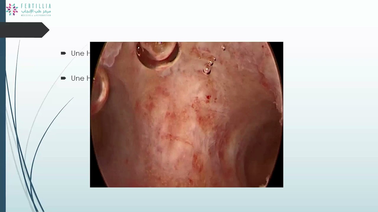 Webinaire # 3 : Prise en charge des fausses couches récurrentes : Update 2021