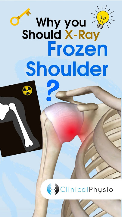 X-Ray Frozen Shoulder? #physicaltherapy #physiotheraphy #frozenshoulder #shoulderpain