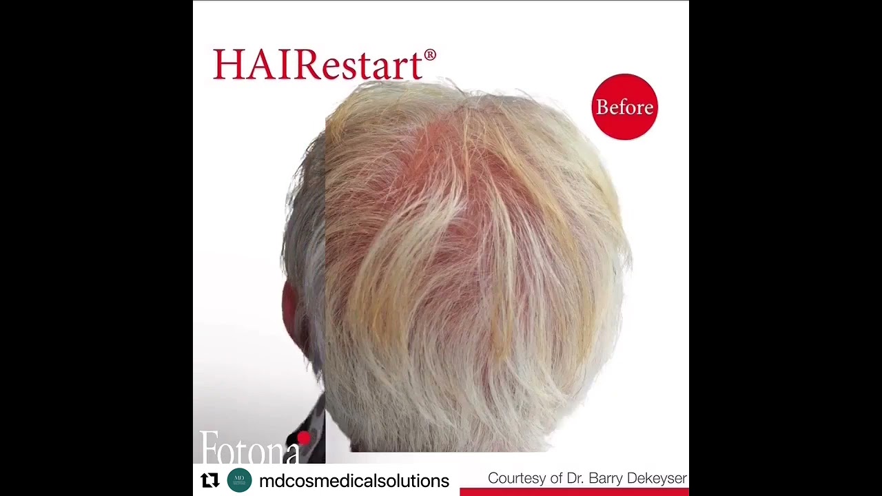 Revolutionary Hair Loss Laser Treatment Sydney, Wahroonga & Canberra by Dr Beaini PH 1300885808