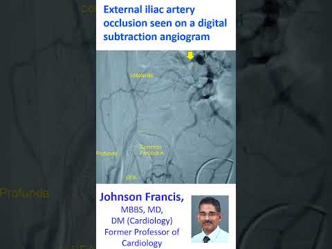 External iliac artery