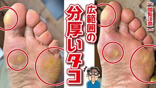 【衝撃】まるで「岩」のような足裏。ガチガチに固まった関節タコと巨大魚の目を完全撤去