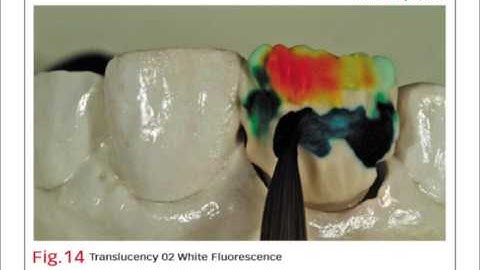 Bench Mastery: Shade matching a single anterior tooth